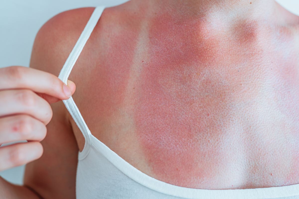 Sonnenbrand in Ravensburg vermeiden und richtig behandeln – 